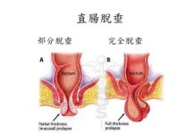 宠物直肠脱出-狗狗直肠脱手术多少钱