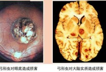 弓形虫检查-弓形虫检查抽血叫什么项目