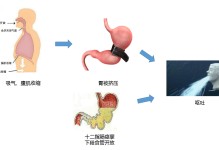 喷射性呕吐是什么-喷射性呕吐是什么细菌感染