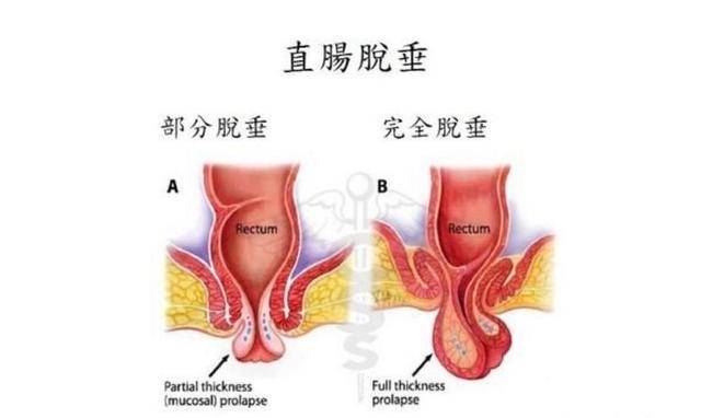 宠物直肠脱出-狗狗直肠脱手术多少钱