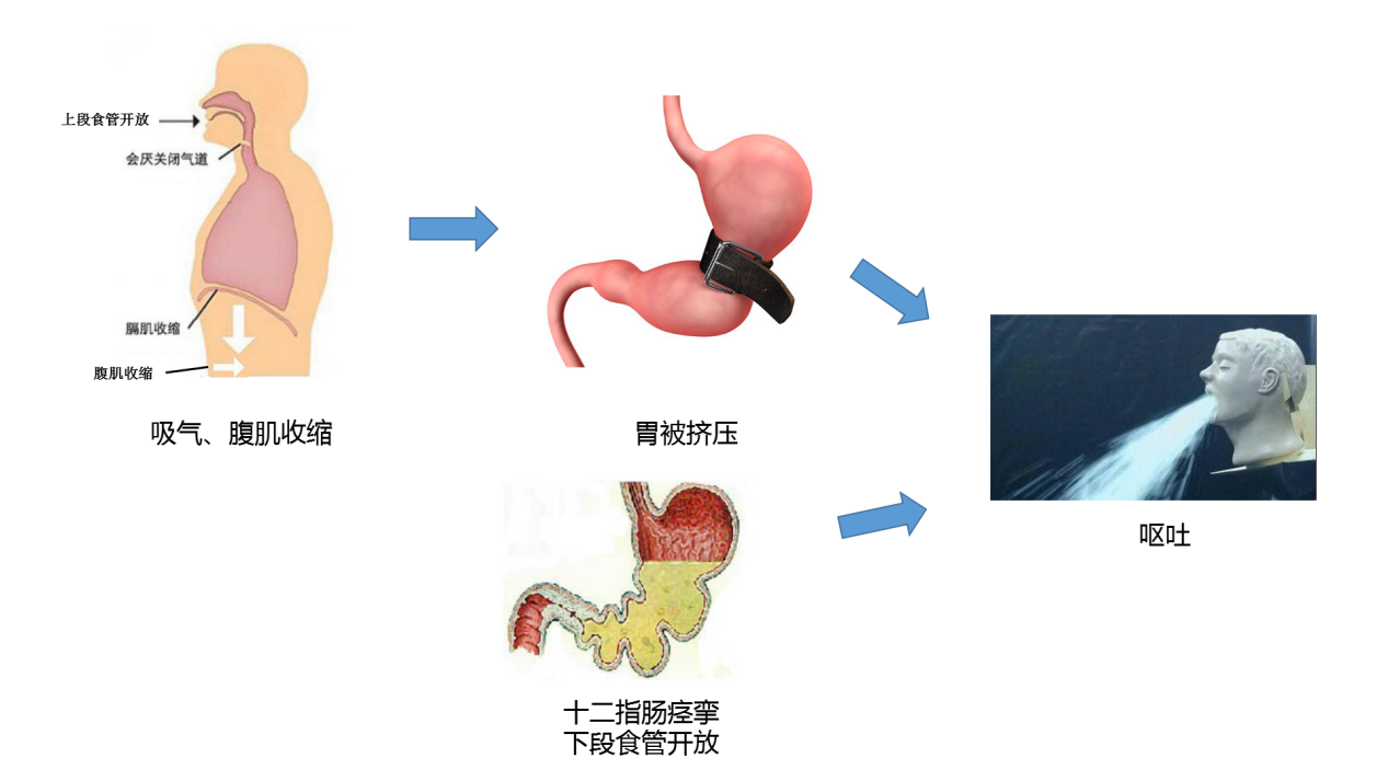 喷射性呕吐是什么-喷射性呕吐是什么细菌感染